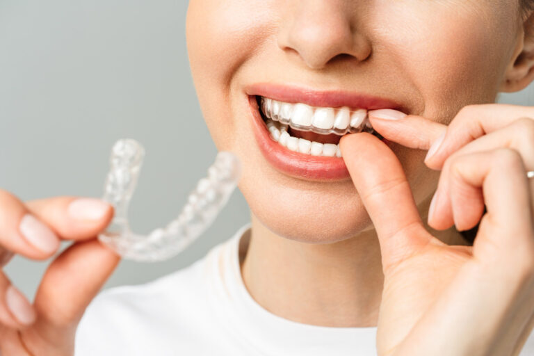 Braces and Aligners